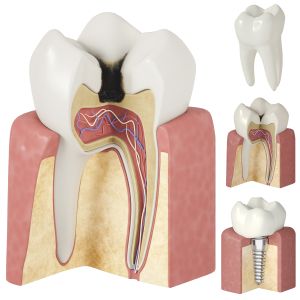 Stages Of Dental Caries And Dental Implant